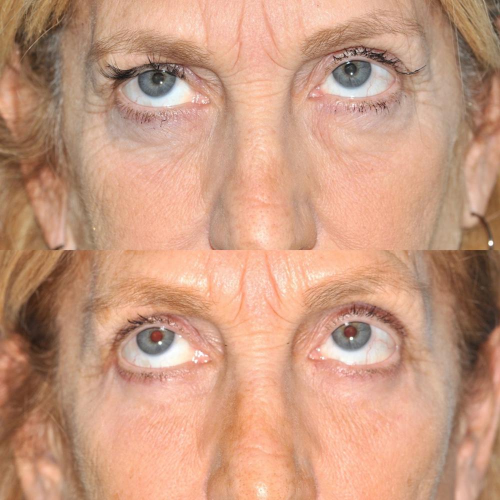 Blepharoplasty Before & After Gallery - Patient 31709255 - Image 3