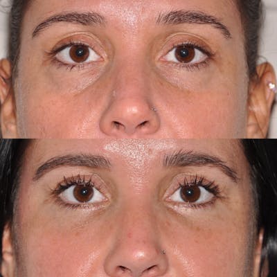 Blepharoplasty Before & After Gallery - Patient 31709257 - Image 1