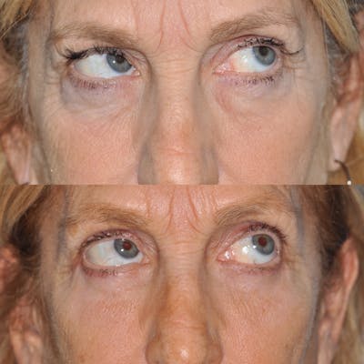 Blepharoplasty Before & After Gallery - Patient 31709255 - Image 4