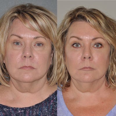 Blepharoplasty Before & After Gallery - Patient 31709258 - Image 1