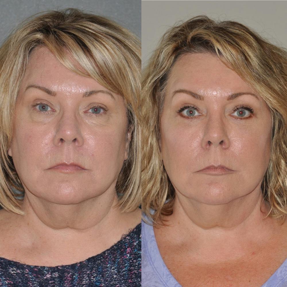 Blepharoplasty Before & After Gallery - Patient 31709258 - Image 1