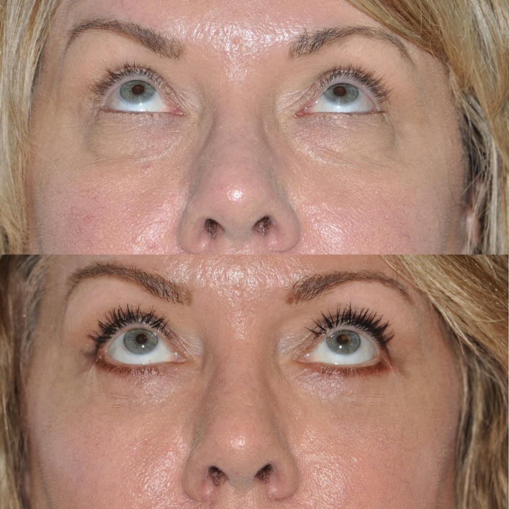 Blepharoplasty Before & After Gallery - Patient 31709258 - Image 2