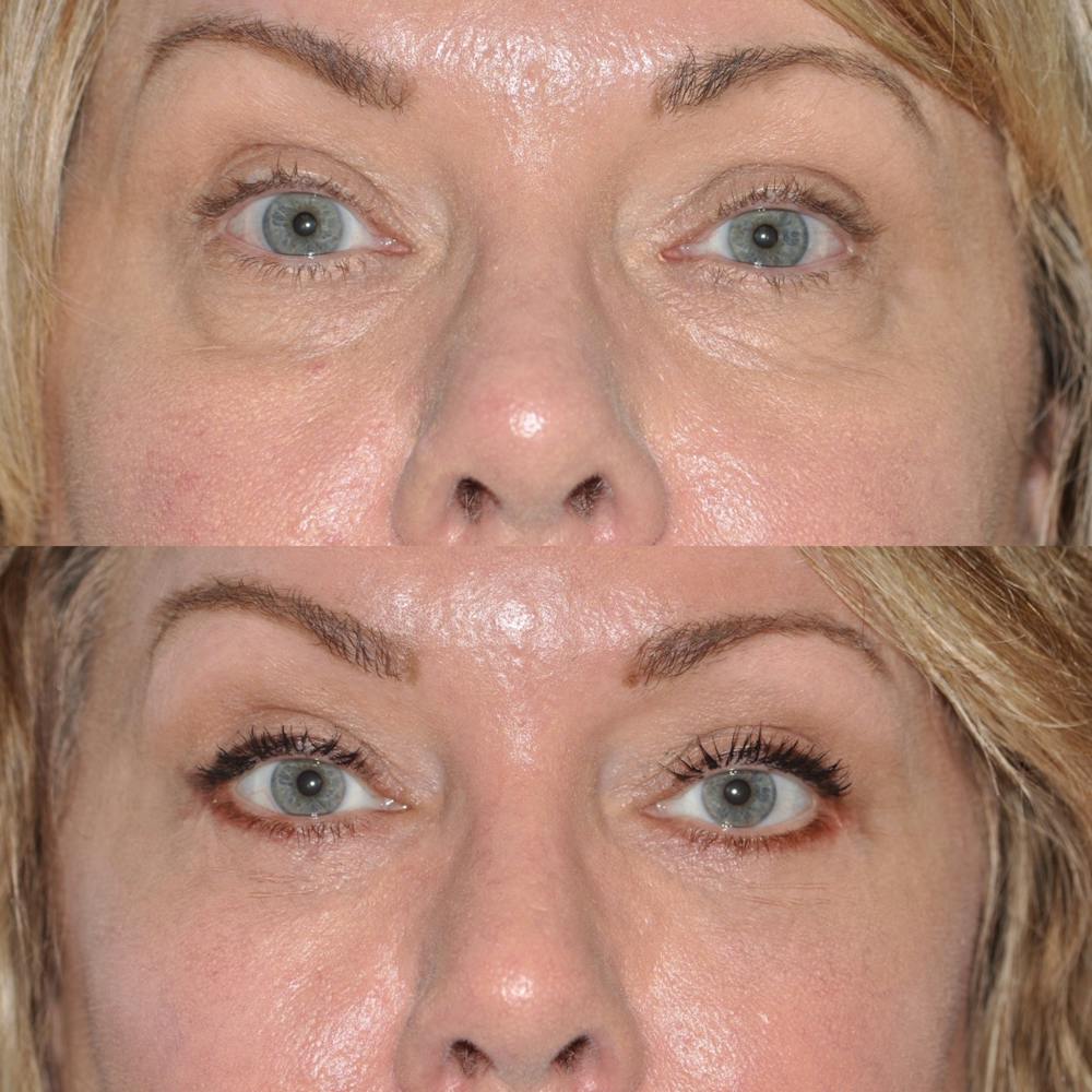 Blepharoplasty Before & After Gallery - Patient 31709258 - Image 3