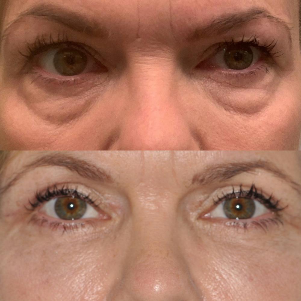 Blepharoplasty Before & After Gallery - Patient 31709259 - Image 1