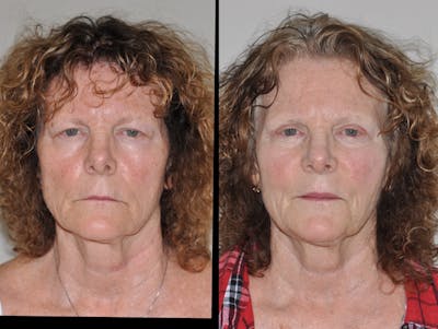 Blepharoplasty Before & After Gallery - Patient 31709260 - Image 1