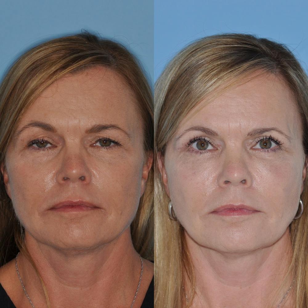 Blepharoplasty Before & After Gallery - Patient 31709259 - Image 2