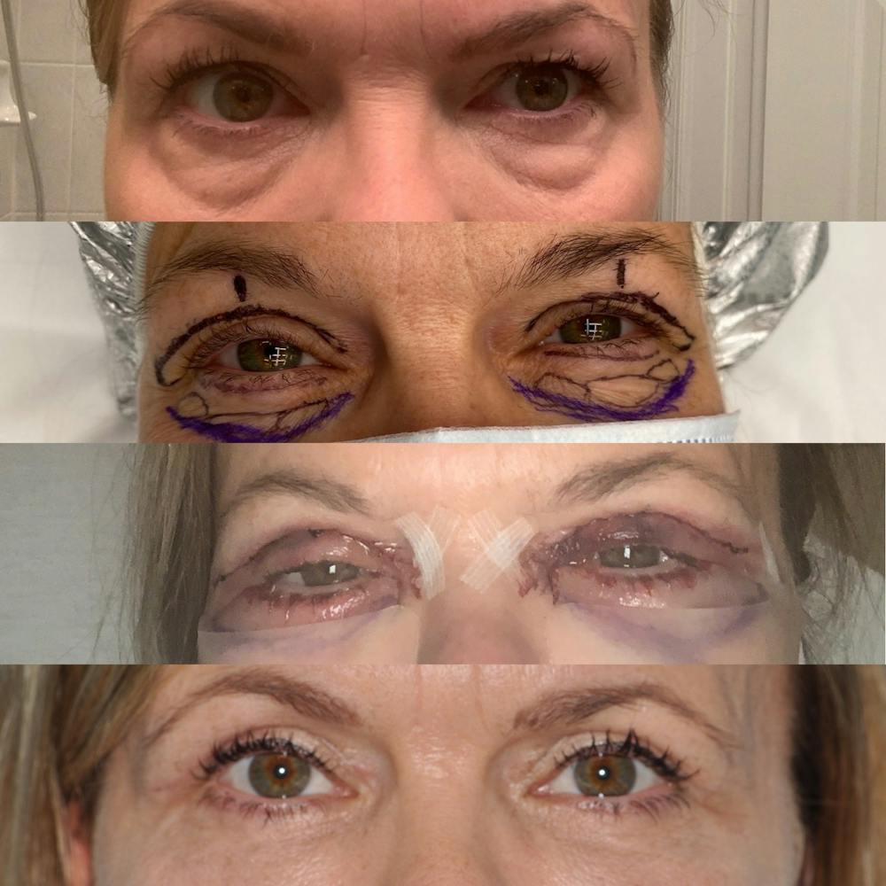 Blepharoplasty Before & After Gallery - Patient 31709259 - Image 3