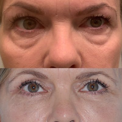 Blepharoplasty Before & After Gallery - Patient 31709259 - Image 4