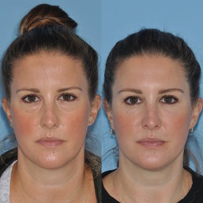 Blepharoplasty Before & After Gallery - Patient 31709262 - Image 1
