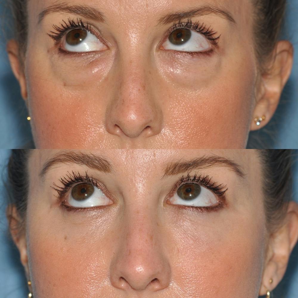 Blepharoplasty Before & After Gallery - Patient 31709262 - Image 3