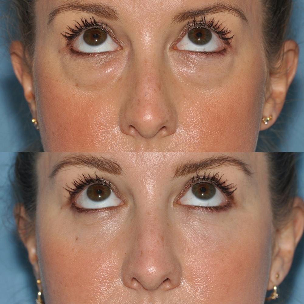 Blepharoplasty Before & After Gallery - Patient 31709262 - Image 4