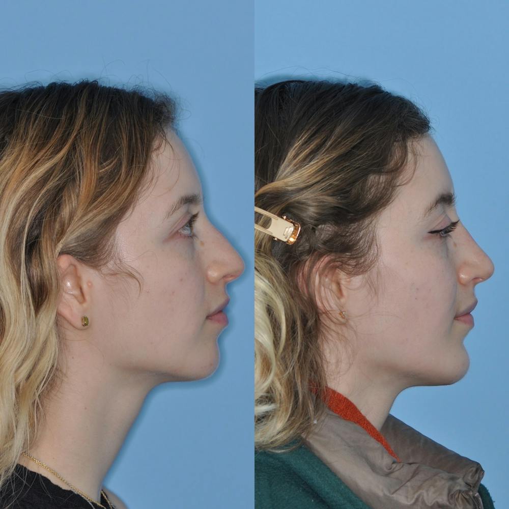 Chin Implants Before & After Gallery - Patient 31709269 - Image 1