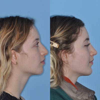 Chin Implants Before & After Gallery - Patient 31709269 - Image 1