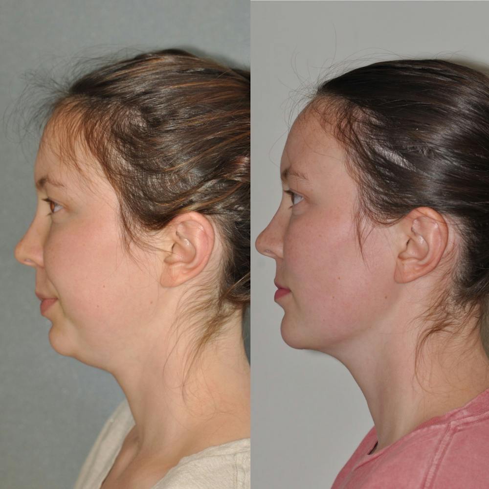 Chin Implants Before & After Gallery - Patient 31709271 - Image 1