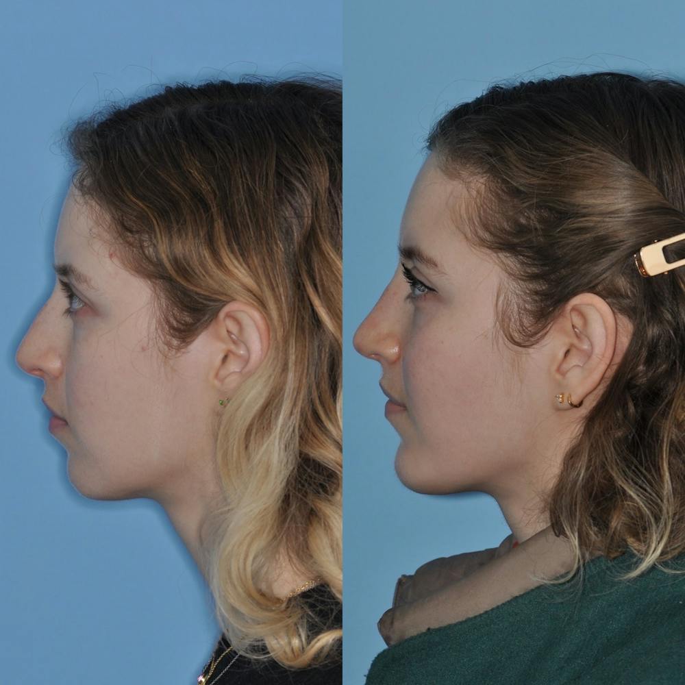 Chin Implants Before & After Gallery - Patient 31709269 - Image 3