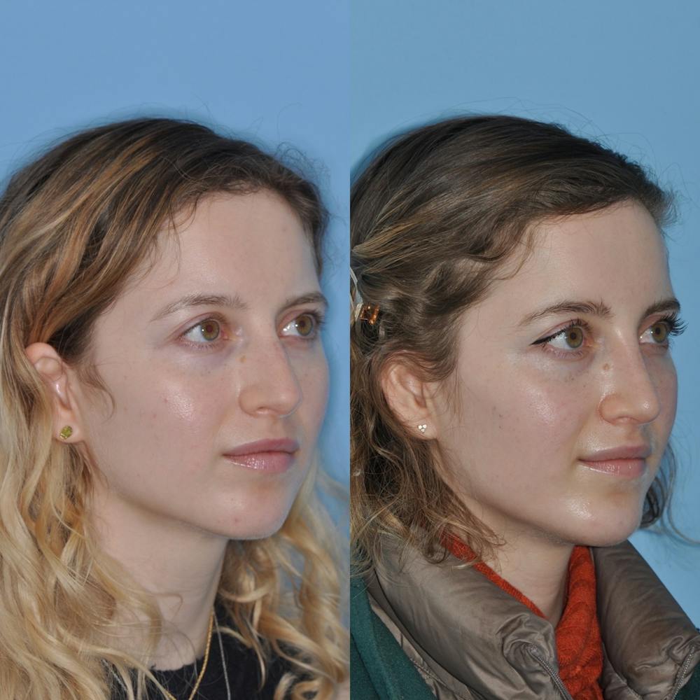 Chin Implants Before & After Gallery - Patient 31709269 - Image 4