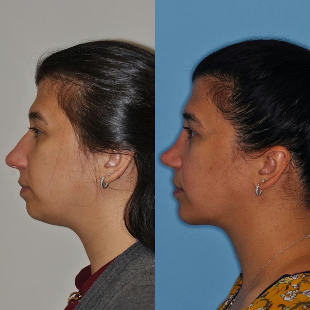 Chin Implants Before & After Gallery - Patient 31709272 - Image 1