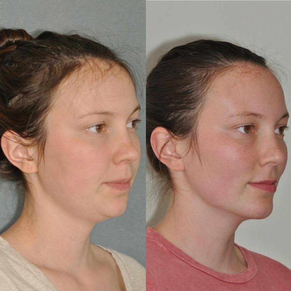 Chin Implants Before & After Gallery - Patient 31709271 - Image 2