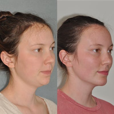 Chin Implants Before & After Gallery - Patient 31709271 - Image 2