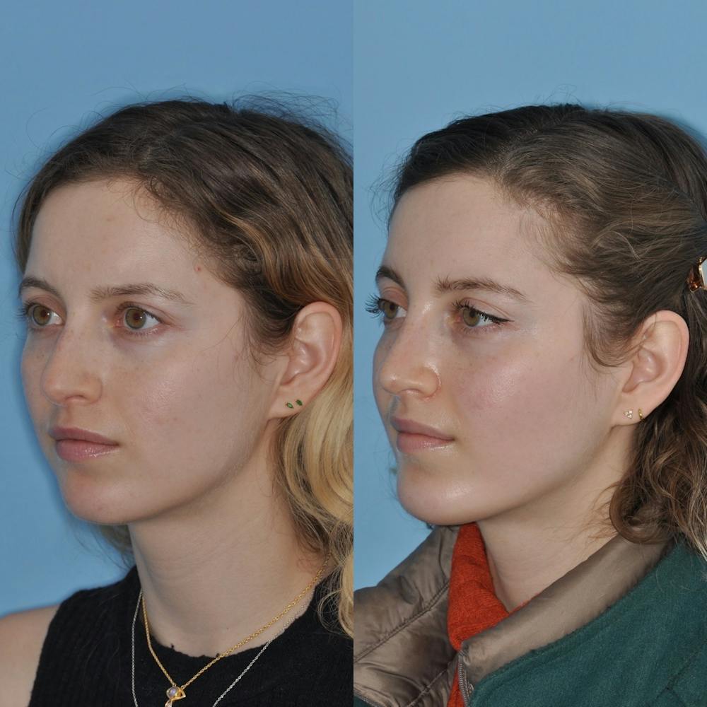 Chin Implants Before & After Gallery - Patient 31709269 - Image 5