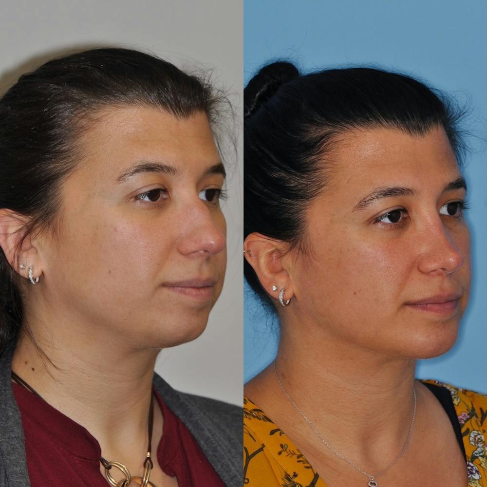 Chin Implants Before & After Gallery - Patient 31709272 - Image 2