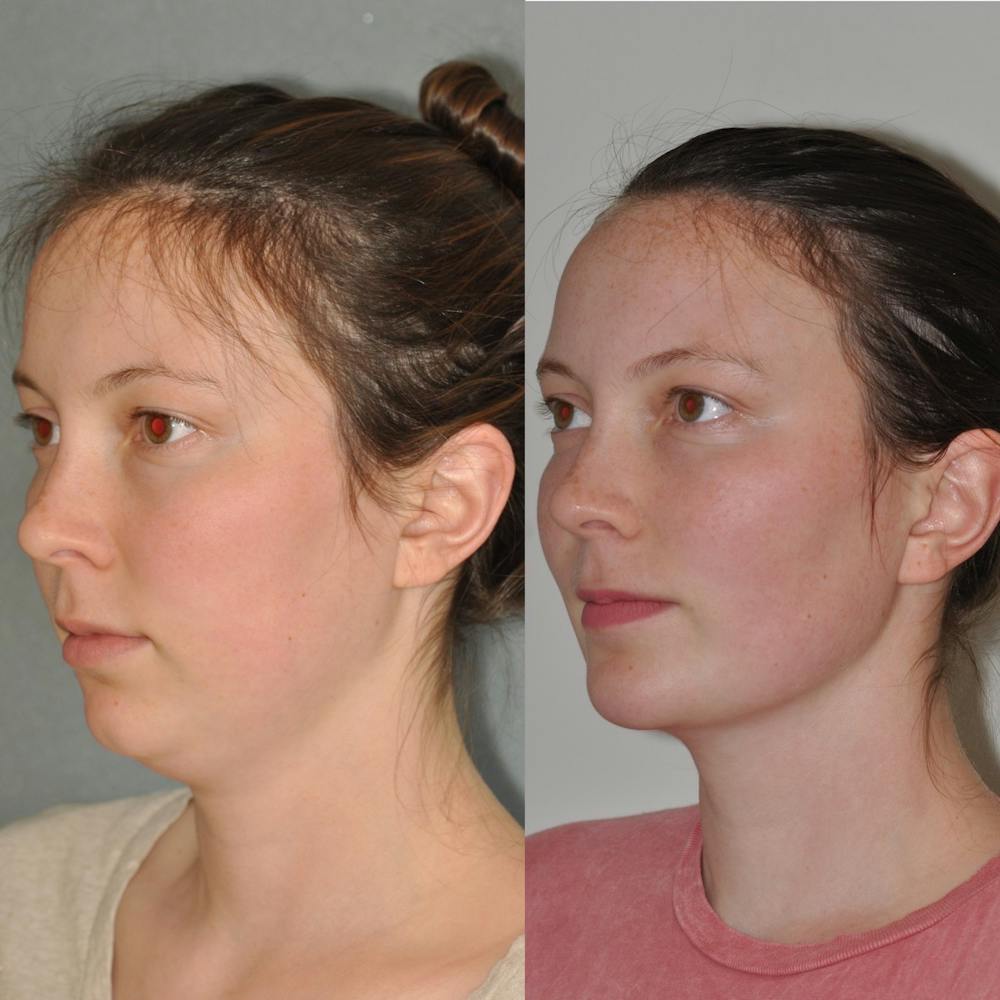 Chin Implants Before & After Gallery - Patient 31709271 - Image 3