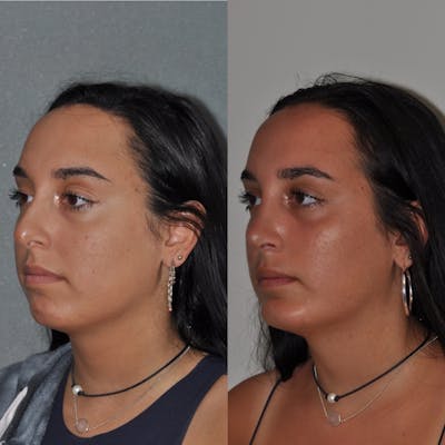 Chin Implants Before & After Gallery - Patient 31709275 - Image 1