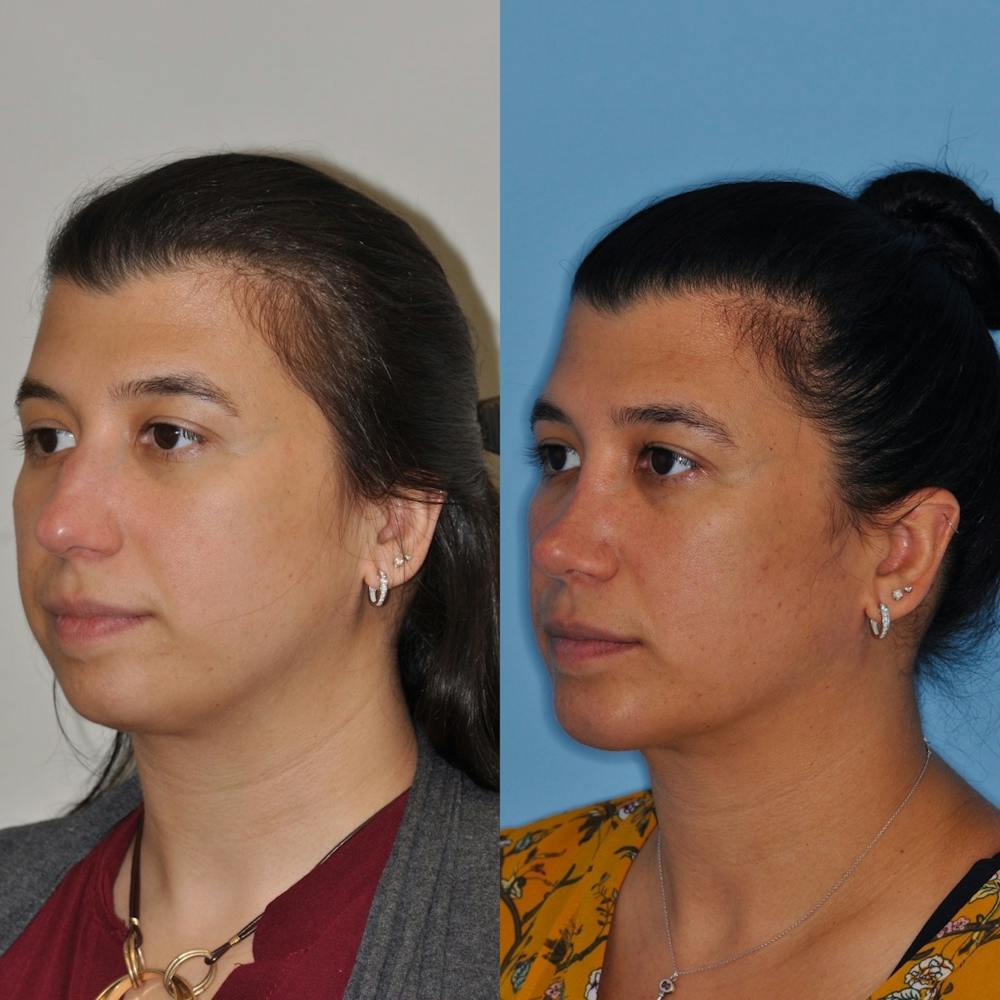 Chin Implants Before & After Gallery - Patient 31709272 - Image 3