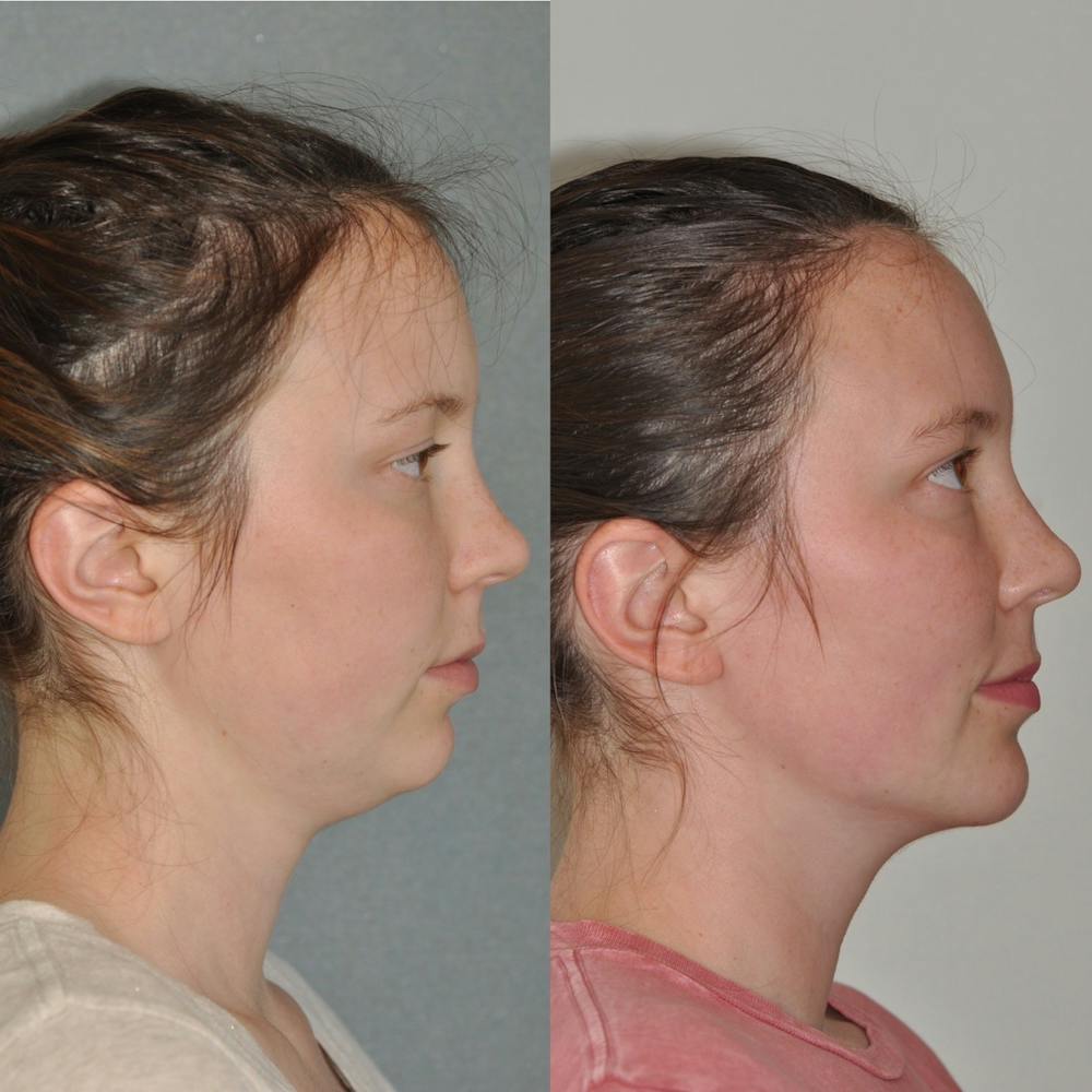 Chin Implants Before & After Gallery - Patient 31709271 - Image 5
