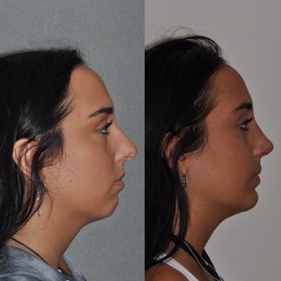 Chin Implants Before & After Gallery - Patient 31709275 - Image 2