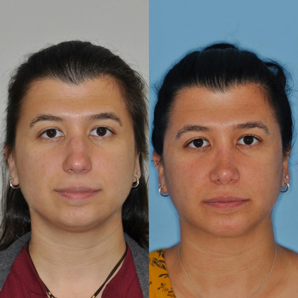 Chin Implants Before & After Gallery - Patient 31709272 - Image 4