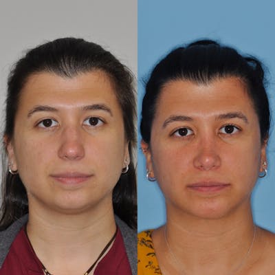 Chin Implants Before & After Gallery - Patient 31709272 - Image 4