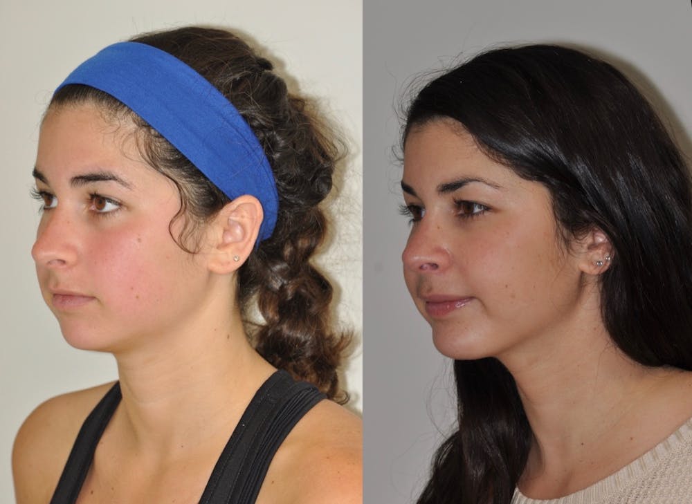 Chin Implants Before & After Gallery - Patient 31709270 - Image 4