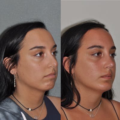 Chin Implants Before & After Gallery - Patient 31709275 - Image 4