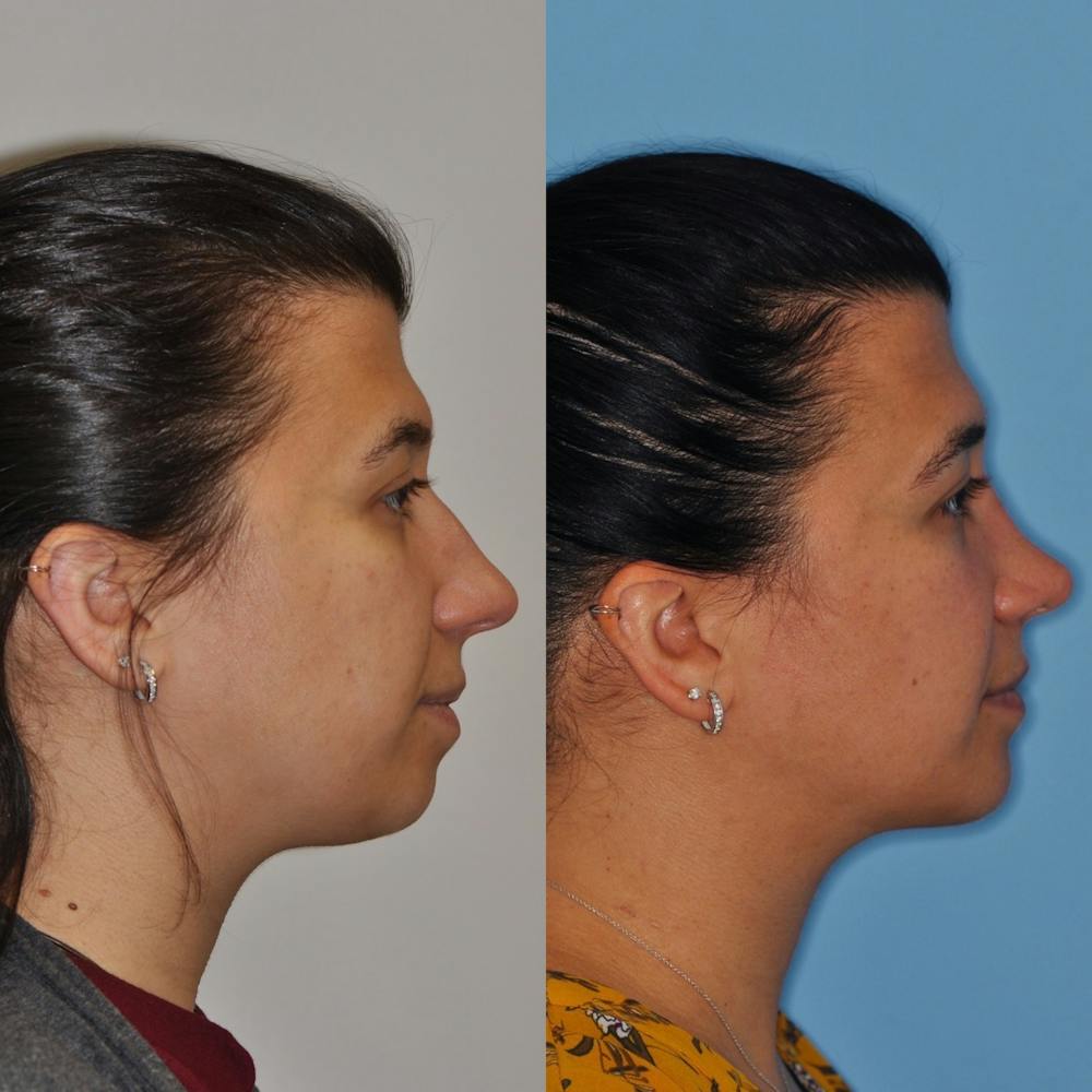 Chin Implants Before & After Gallery - Patient 31709272 - Image 5
