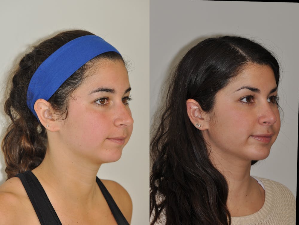 Chin Implants Before & After Gallery - Patient 31709270 - Image 5