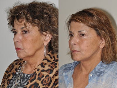 Facelift Before & After Gallery - Patient 31709459 - Image 1