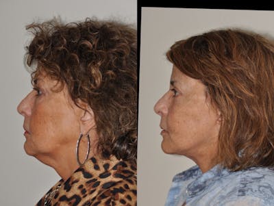 Facelift Before & After Gallery - Patient 31709459 - Image 2