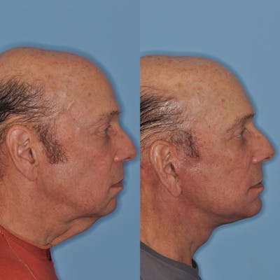 Facelift Before & After Gallery - Patient 31709461 - Image 1