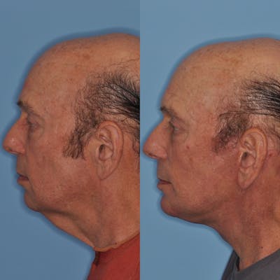 Facelift Before & After Gallery - Patient 31709461 - Image 2