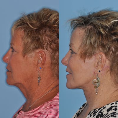 Facelift Before & After Gallery - Patient 31709462 - Image 2