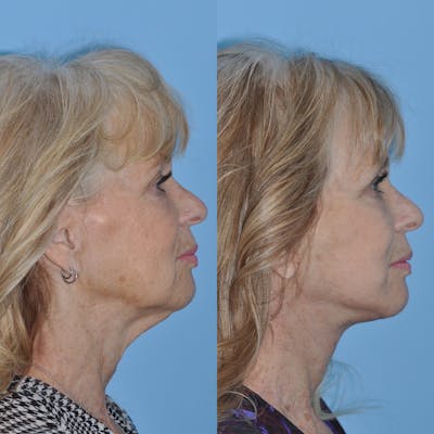 Facelift Before & After Gallery - Patient 31709463 - Image 1