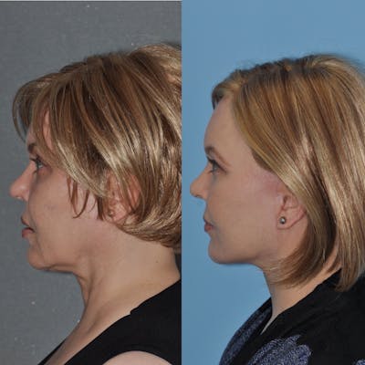 Facelift Before & After Gallery - Patient 31709464 - Image 1