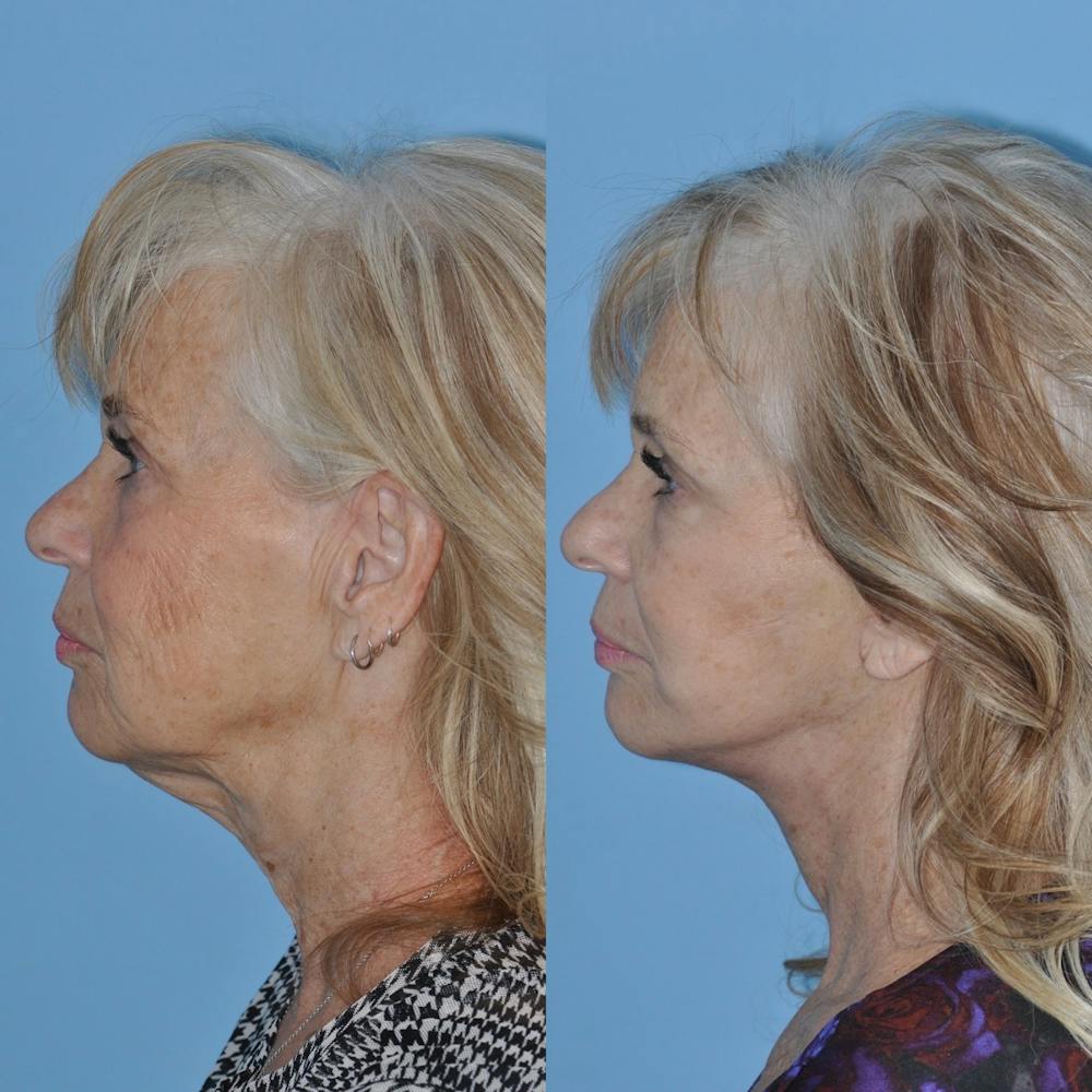 Facelift Before & After Gallery - Patient 31709463 - Image 3