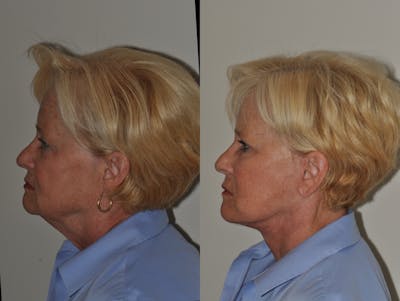 Facelift Before & After Gallery - Patient 31709465 - Image 1