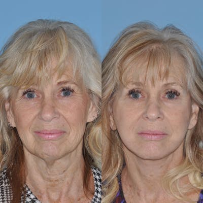 Facelift Before & After Gallery - Patient 31709463 - Image 4
