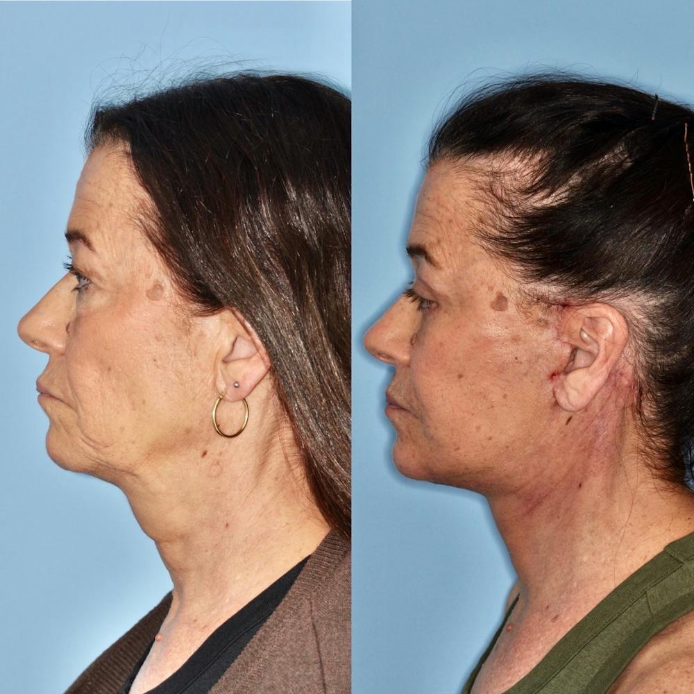 Facelift Before & After Gallery - Patient 31709466 - Image 1