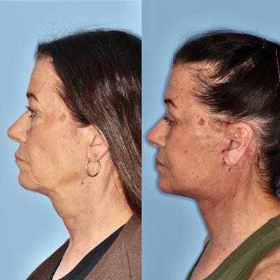 Facelift Before & After Gallery - Patient 31709466 - Image 1