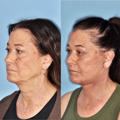 Facelift Before & After Gallery - Patient 31709466 - Image 2