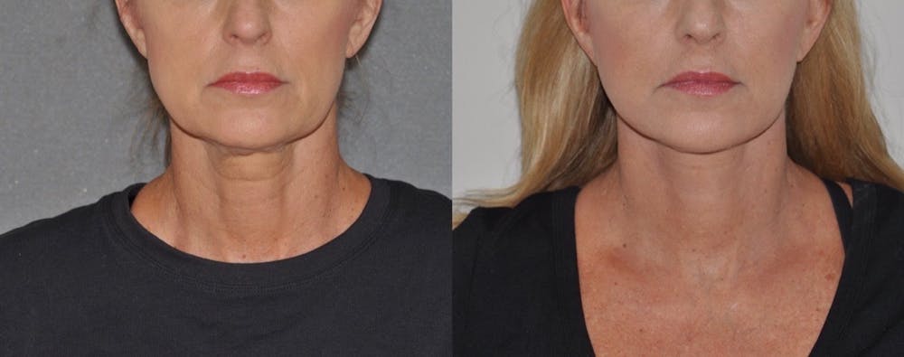 Facelift Before & After Gallery - Patient 31709467 - Image 1